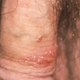 Illustration for article titled Cara Menyembuhkan Penyakit Herpes Genital